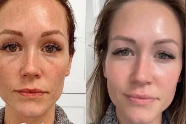 Korean skincare transformation using RIMAN ICD Signature Ritual 